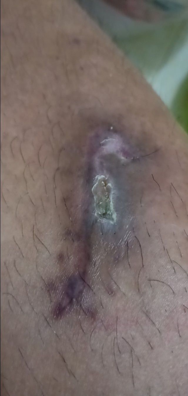 双氧水洗伤口导致周边红肿,伤口结痂感染用双氧水可以杀菌吗