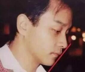 不用手术的鼻子塌陷扁平的解决方法？▼