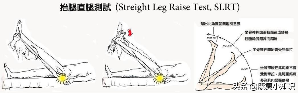 大腿后侧疼痛的位置图,大腿后侧根部疼痛