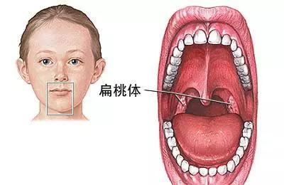 扁桃体容易发炎可以割掉吗,扁桃体老是发炎怎么彻底根治