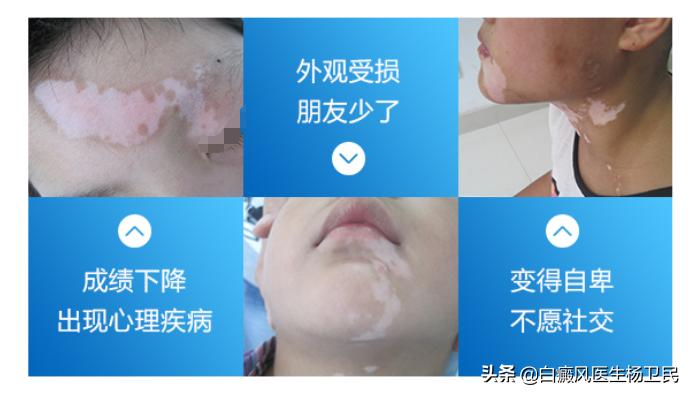 哪些误区阻挡你的白斑消除,白斑的真正可怕之处