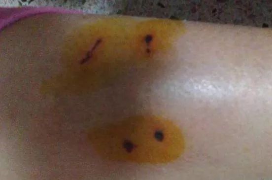 被仓鼠咬伤也要注射狂犬疫苗吗,被仓鼠抓伤了没出血要狂犬疫苗吗