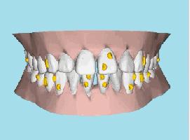 牙龈上有白色的牙垢刷不掉,牙龈里的黑东西