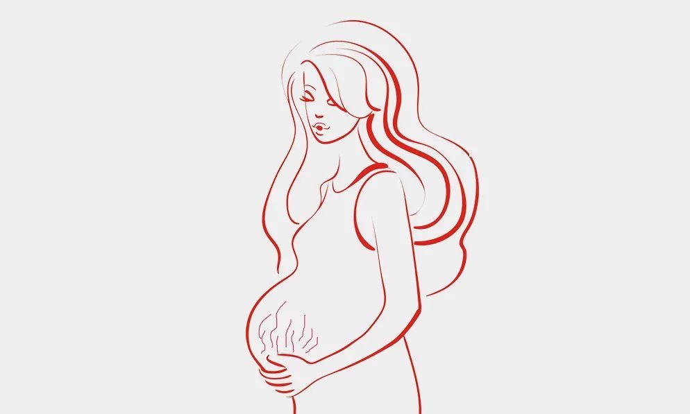 怀孕妊娠纹怎么可以彻底消除,怀孕期间出现妊娠纹怎么办