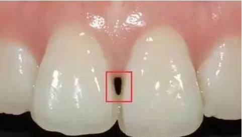 牙龈萎缩黑三角塞牙,牙齿黑三角如何让牙龈长出来