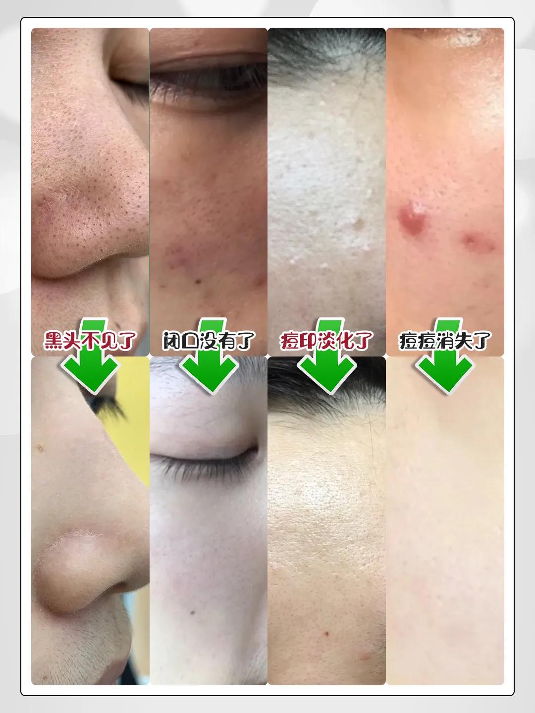 女孩青春期皮肤粗糙如何改善,青春期怎样让皮肤变得细腻