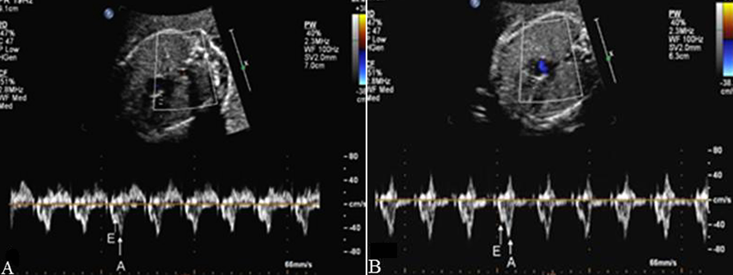 胎儿超声心动图报告解读,胎儿彩色多普勒超声心动图