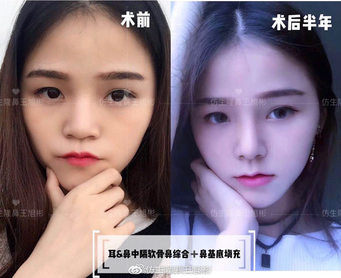 大宽朝天鼻整形过程,窄鼻子如何通过鼻整形来矫正