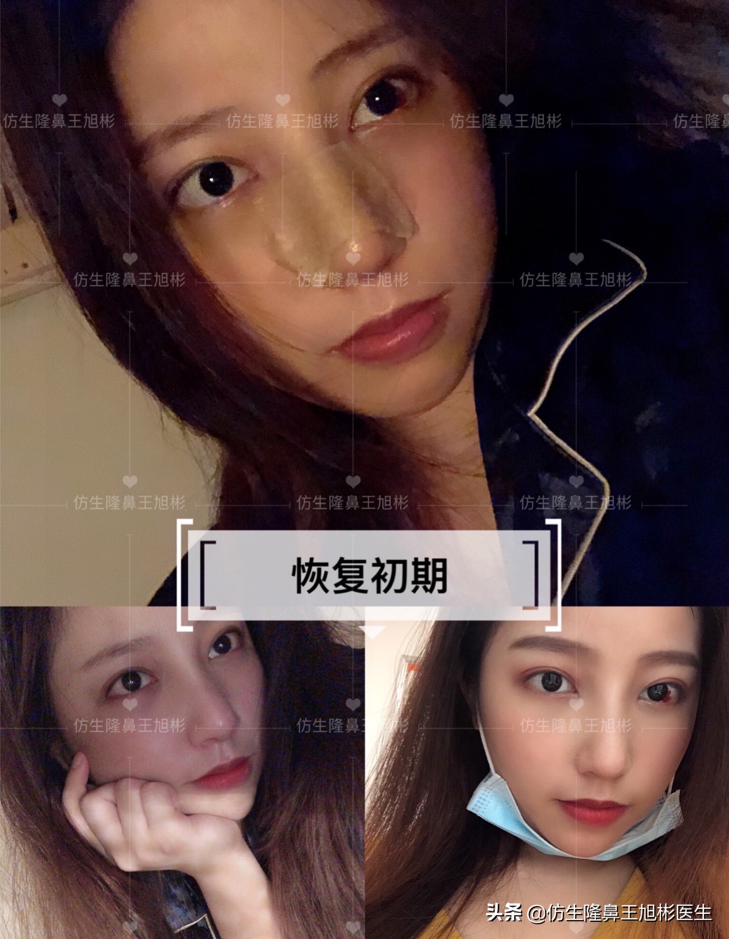 手术鼻头增厚能用什么方法弄,大鼻头高鼻梁缩小手术案例