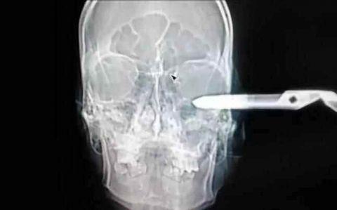 不作死就不会死，看看这些被人类搞进身体里的异物