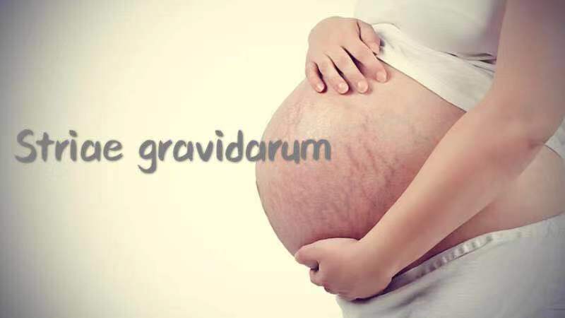 如何避免出现妊娠纹这5步要做好,怎么预防妊娠纹的发生