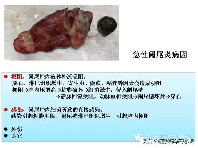 阑尾炎课件,阑尾炎的超声课件