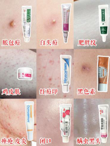 痘痘治疗推荐,闭口黑头痘痘痘印用什么药膏