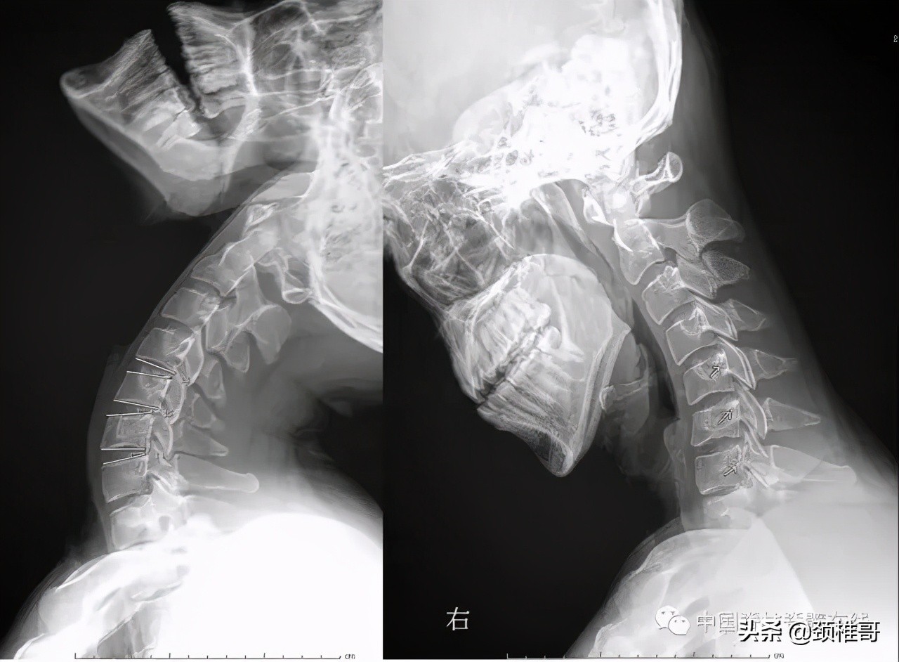 颈椎病的护理临床路径流程图,颈椎病的健康管理与康复指导