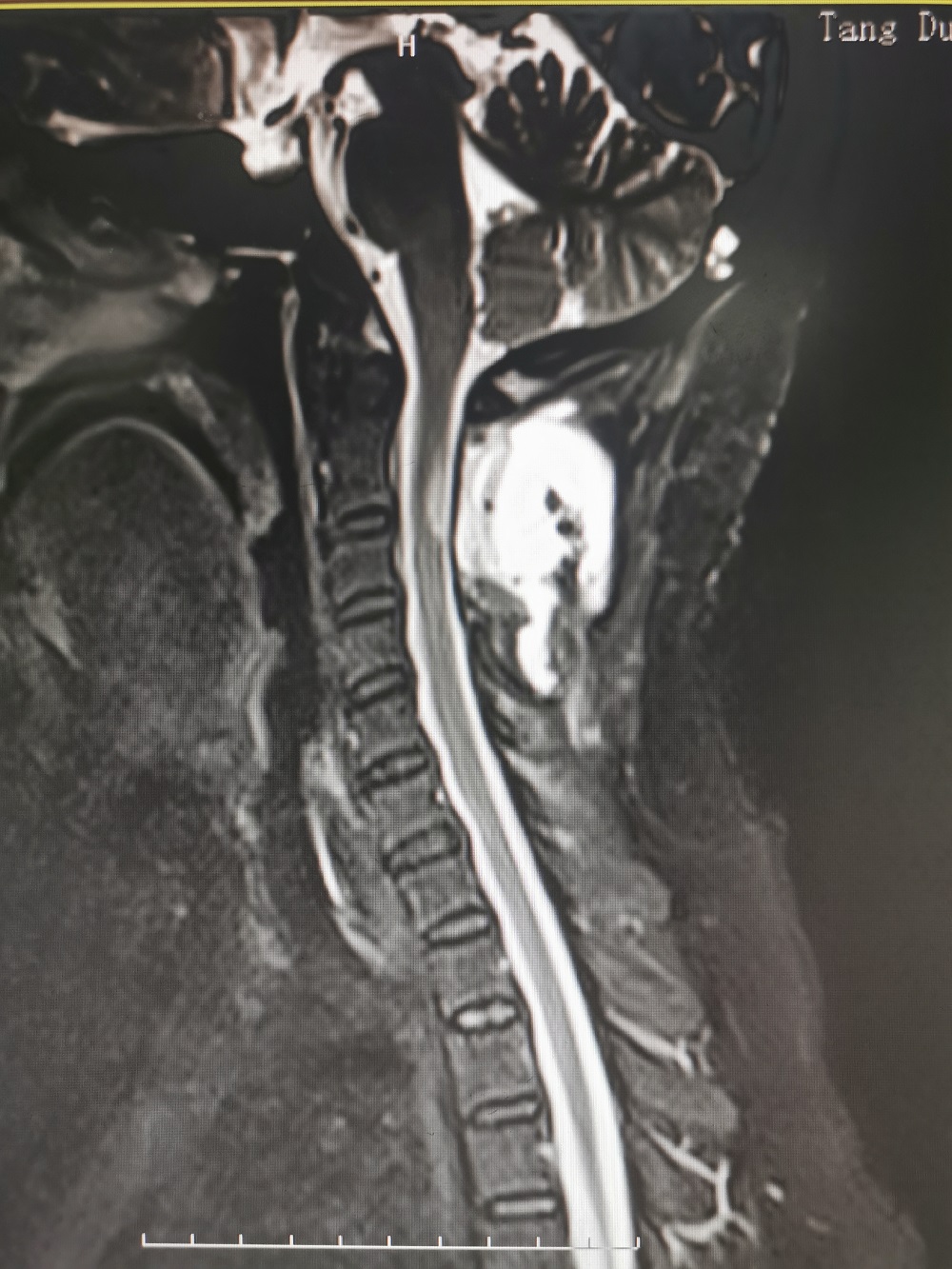 无缘无故手麻木伸不直,无缘无故两手发麻是什么情况