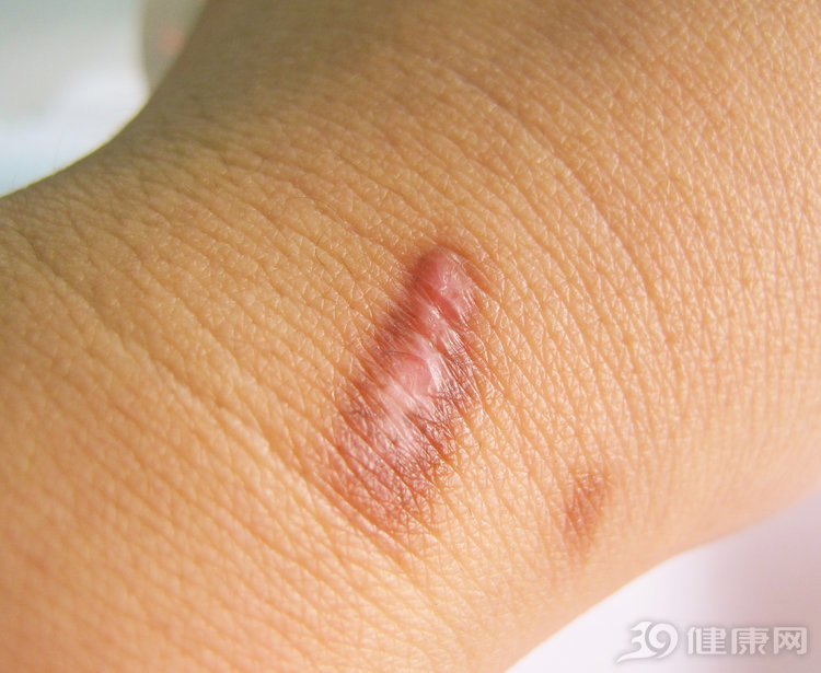 烫伤急救正确步骤5字,烫伤急救五步法宣传