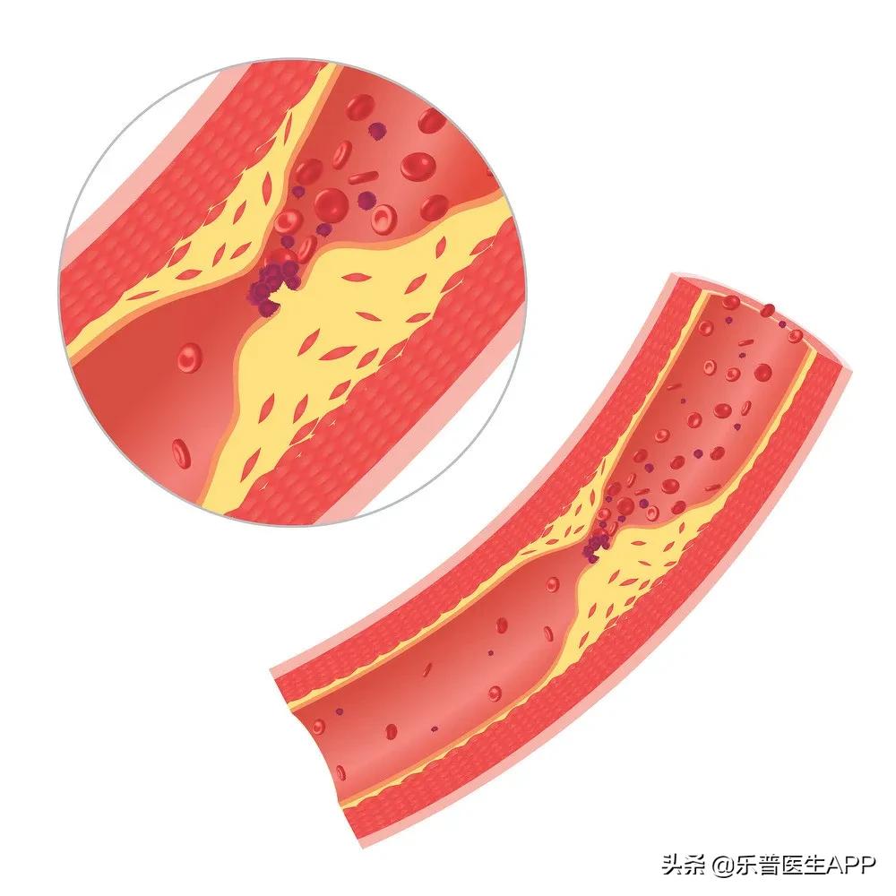 心脏血管堵塞80%可以疏通血管吗,血管堵塞80%还能缓解吗