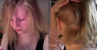 拔毛癖需要治疗吗,怎么能戒掉拔毛癖