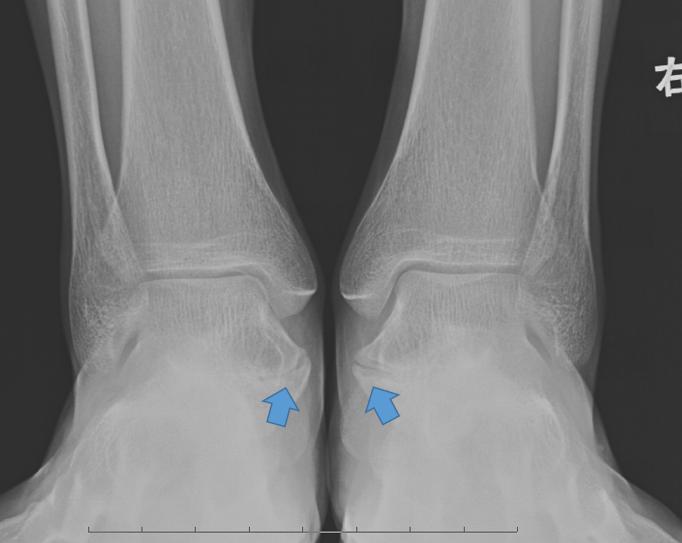 小孩玩多了脚酸脚痛怎么回事,小孩子玩着玩着就脚痛