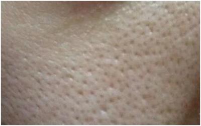 怎么改善毛孔粗大小痘痘,毛孔粗大痘痘改善方法