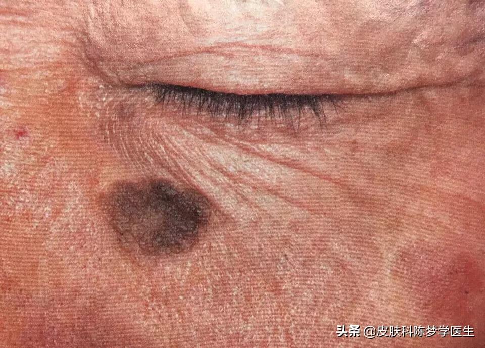 褐青色痣斑吃什么中药好,如何治疗脸上褐青色痣样斑