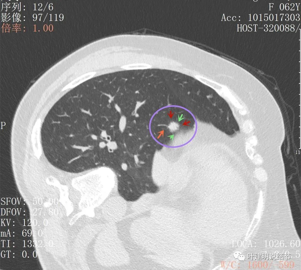左肺癌手术半年右肺下角还有炎症,左下肺癌晚期