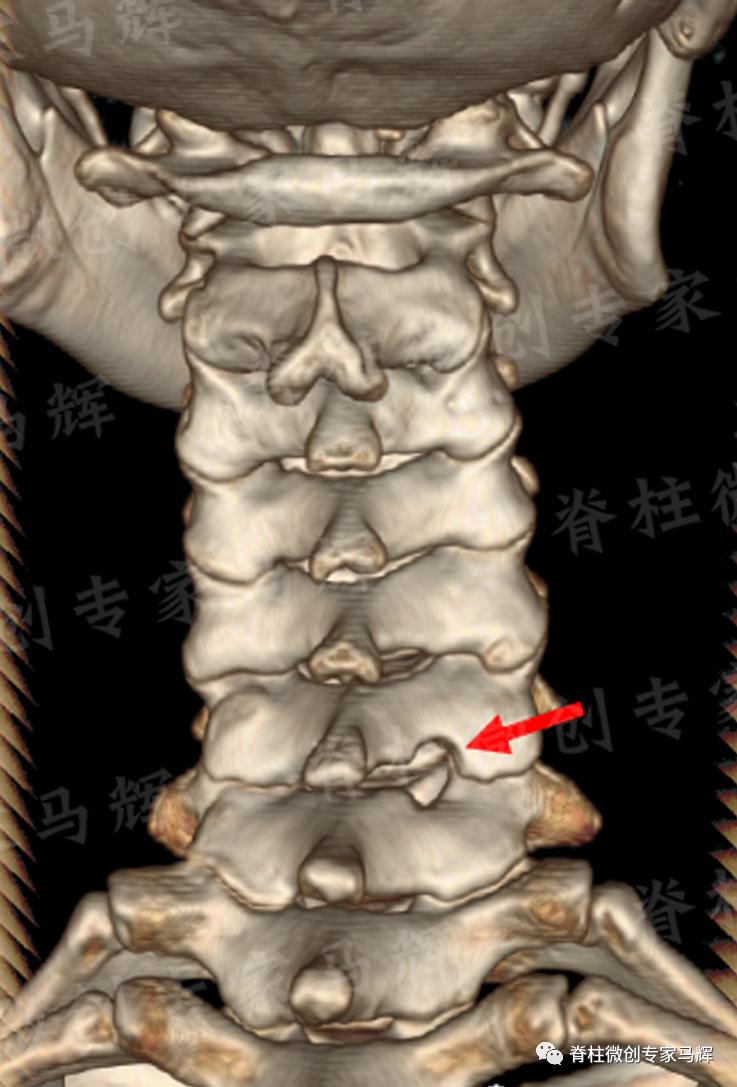 脊椎压迫神经做了微创术后腿麻疼,神经根损伤疼痛治疗
