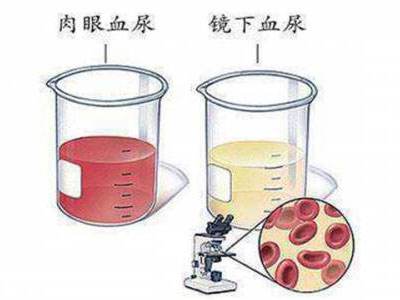 体检出现尿潜血该怎么避免,体检发现尿潜血怎么办