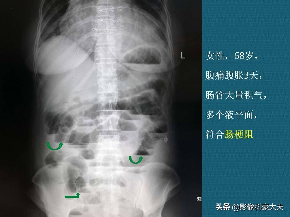 6天没排便，住院洗肠，孩子埋怨浪费3000块