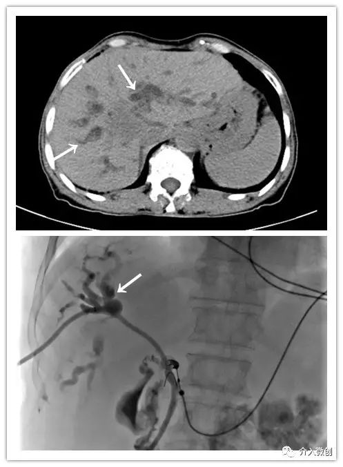 肝癌切除术后的辅助治疗选择,晚期肝癌肝硬化不能做手术怎么办