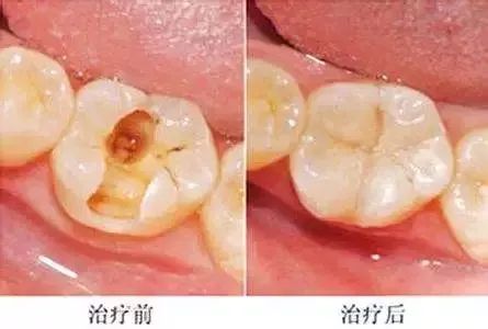 不进行根管治疗就补牙会怎么样,补牙杀神经和根管治疗是一回事吗