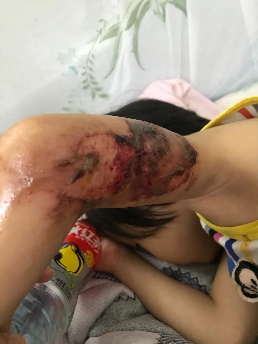 孩子大面积烫伤治疗流程,记录女儿被烫伤到治疗全过程