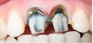 做了烤瓷牙后悔了有补救办法吗,做了烤瓷牙后悔了怎么补救