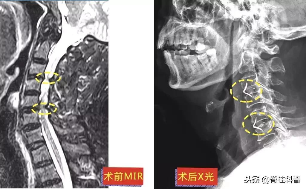 脊髓型颈椎病急刹车,严重颈椎病早期的10大症状