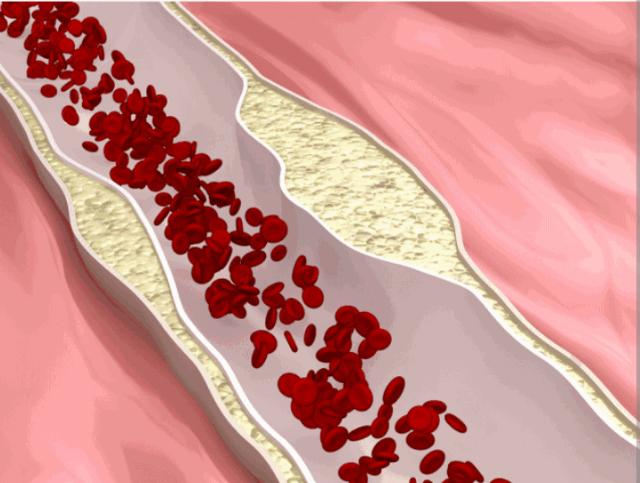 如何降低高脂血症,想降低体脂早上吃什么药