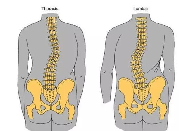 骨盆前倾对身体有什么影响,骨盆前倾最好的解决方法