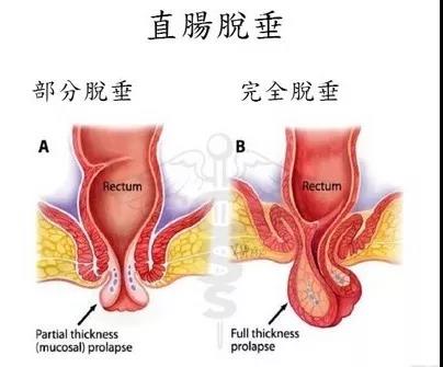 肛门坠胀老是有便意排不出来,肛门坠胀老有便意感觉有气排不出