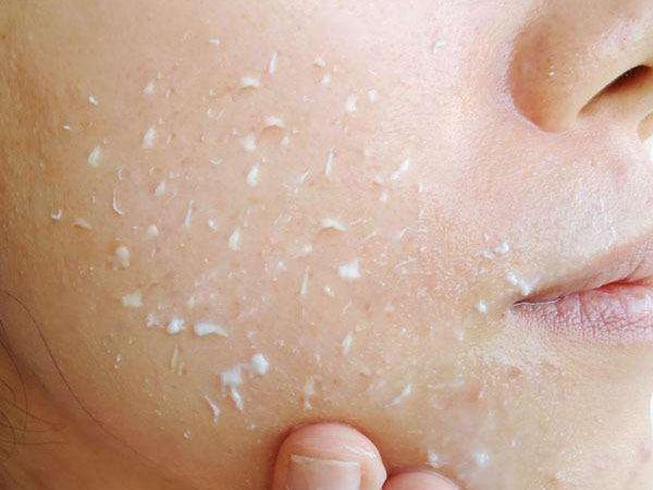 教你如何去除闭合性粉刺,胸前闭合性粉刺闭口怎么去除