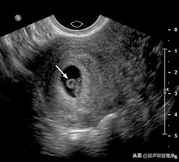 3毫米卵黄囊未见胎芽正常么,40多天的卵黄囊