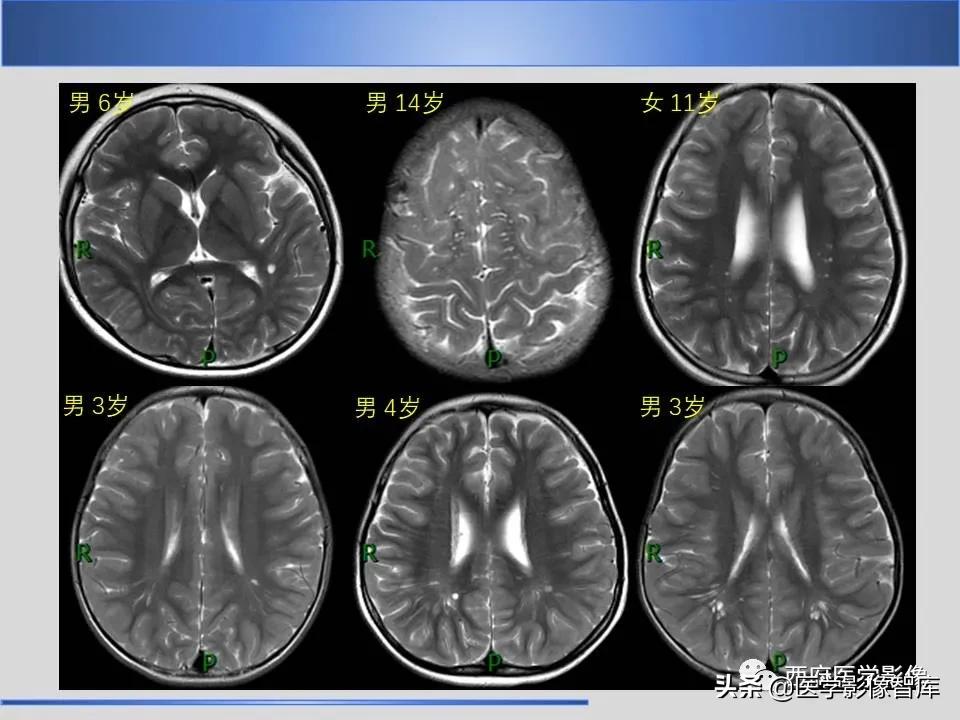 vr间隙概念,vr间隙需要做什么检查