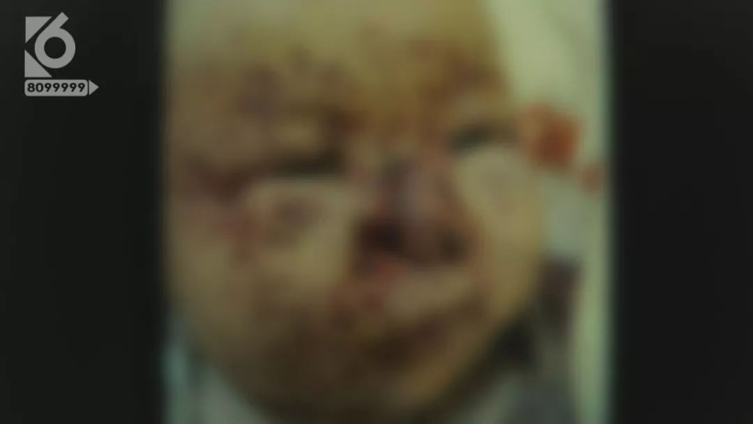 老鼠啃三个月婴儿事件,婴儿熟睡时被老鼠啃食新闻