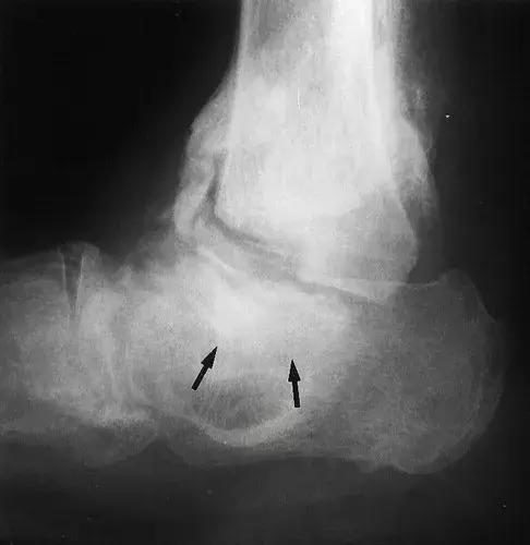 神经性骨关节病,神经性关节炎症状图片