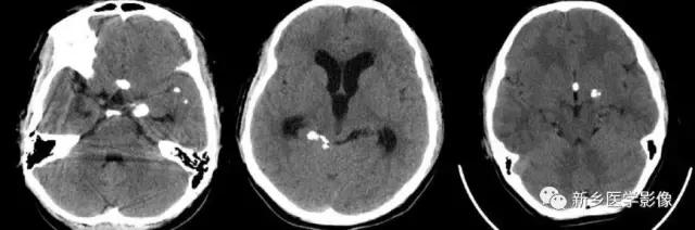 颅内有钙化怎么治疗,34岁脑部有钙化正常吗