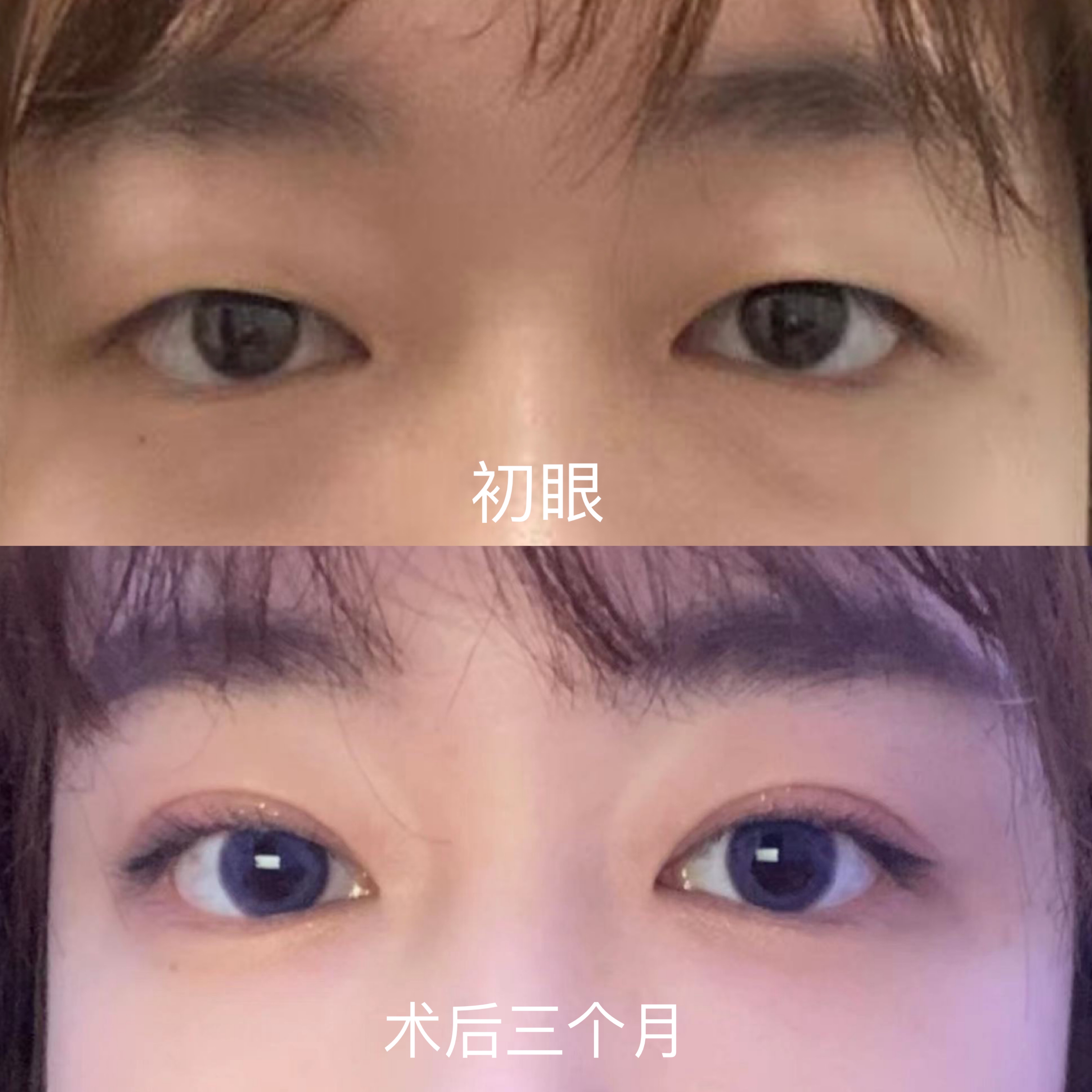 双眼皮手术详细教程,埋线双眼皮手术全过程