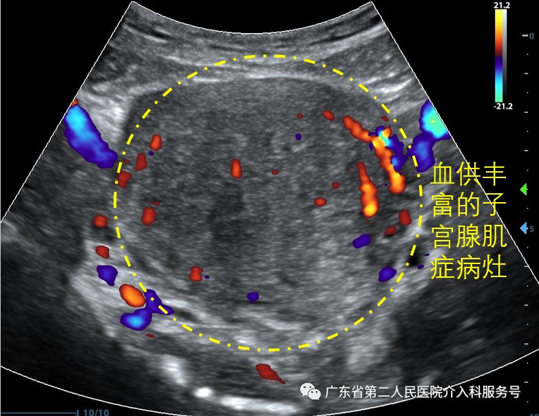 痛经消融手术,痛经微创