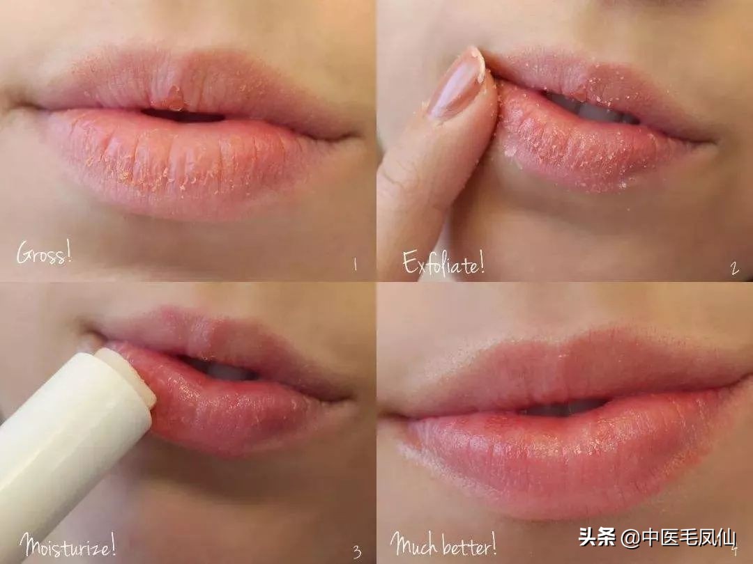 嘴唇干裂脱皮是唇炎还是脾虚,小孩经常喝水嘴唇还是干裂为什么