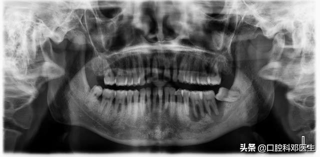 牙周炎引起门牙缝隙变大吗,牙周炎导致门牙往外突特别严重