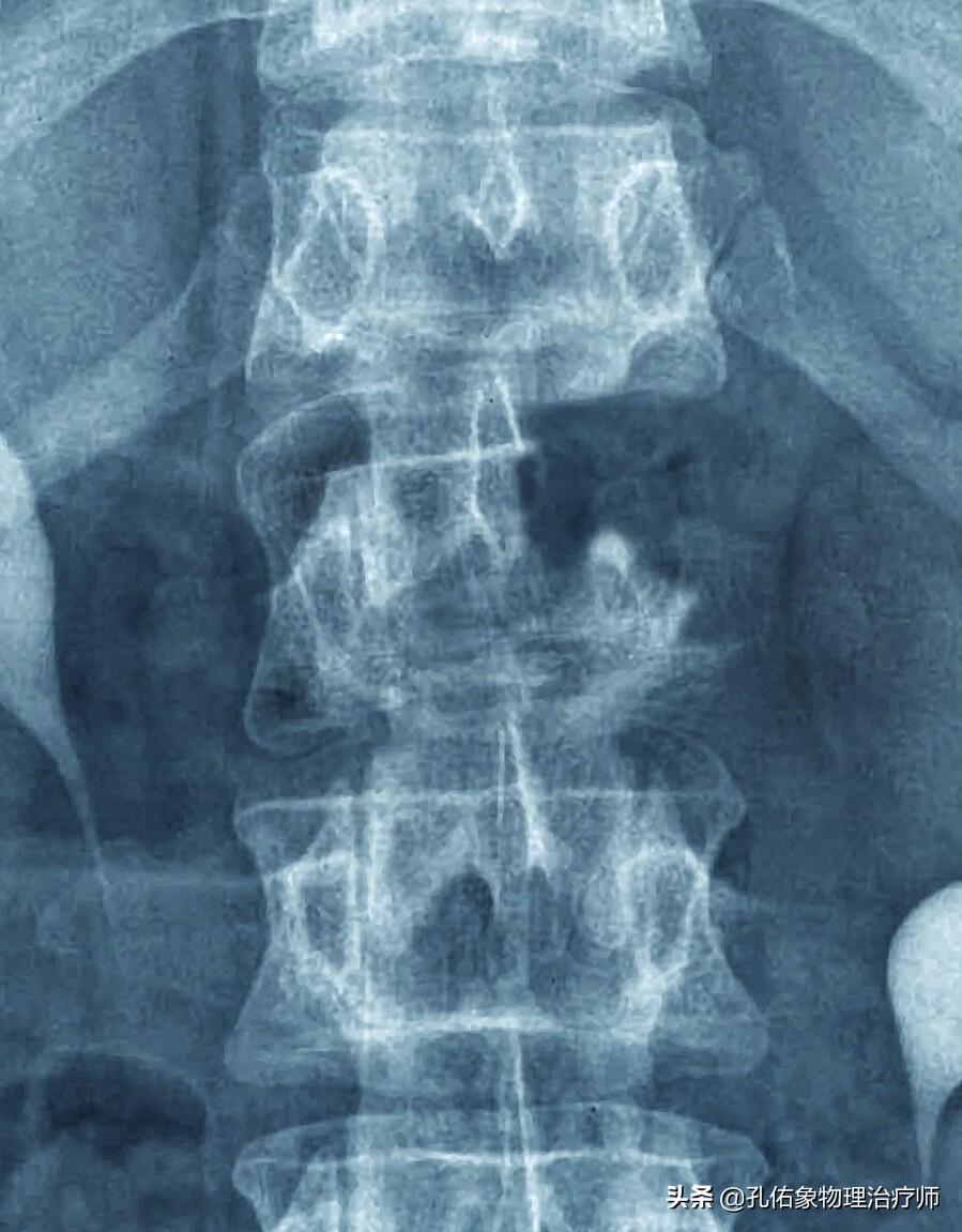 手指肿胀有硬硬的感觉,手指有结节有僵硬疼痛是什么病