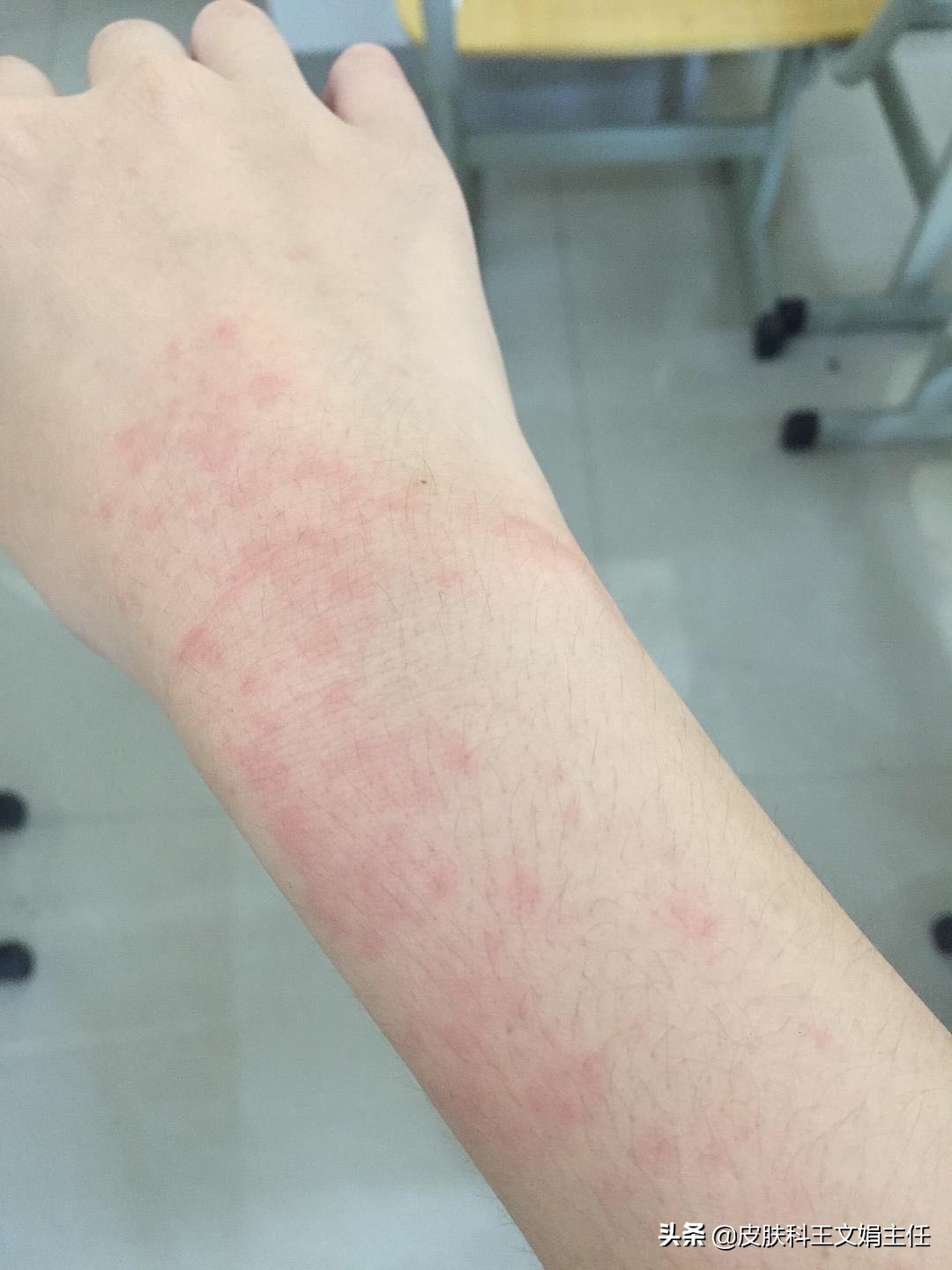 夏季常见皮肤病及用药,应对夏季常见皮肤病的小妙招