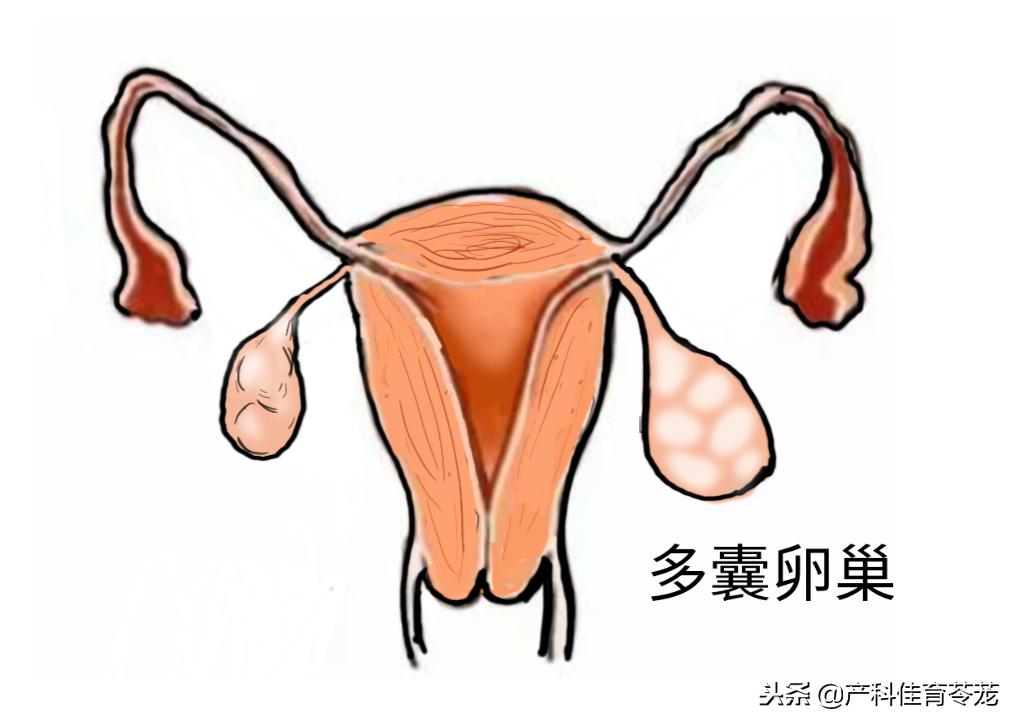 卵巢囊肿术后还有囊肿,卵巢囊肿是肿瘤性囊肿怎么治疗